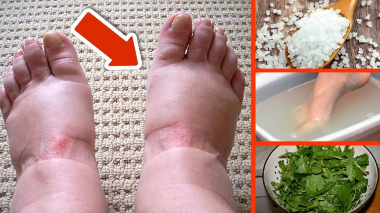 5 Rimedi Naturali Efficaci Per Alleviare I Piedi Gonfi Subito!