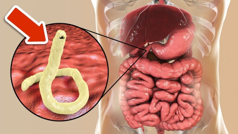Elimina i parassiti intestinali in 4 semplici passi naturali! Scopri come!