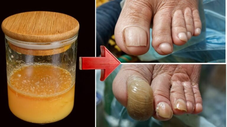 Sconfiggi il fungo delle unghie: 5 rimedi semplici per unghie sane!
